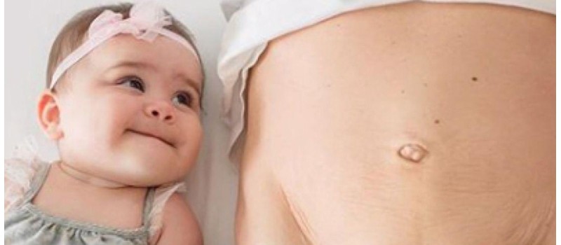 Diastază abdominală - cum ne recuperăm după naștere